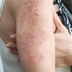 La Malattia della pelle Eczema